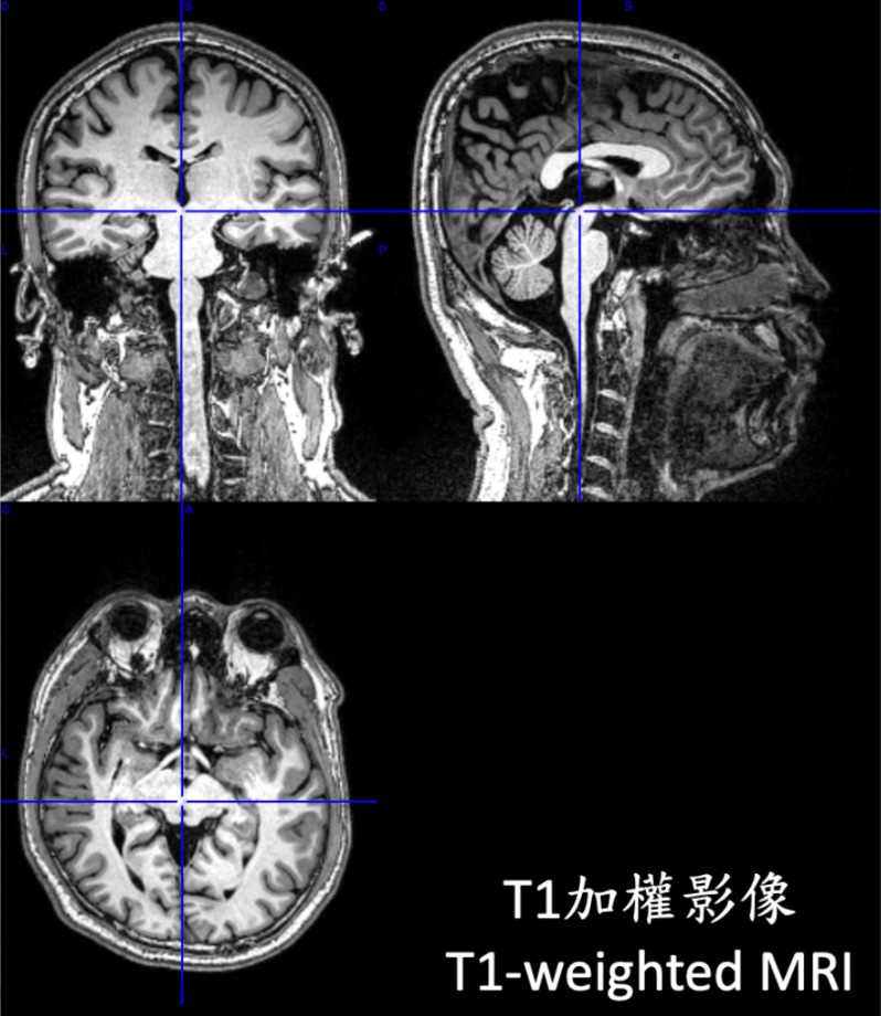 大腦由灰質、白質與脊隨液構成。本研究則專注於腦部灰質的結構比較。　圖／團隊提供